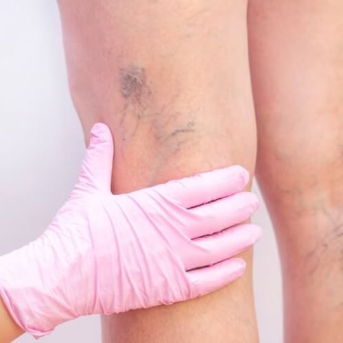 pernas-femininas-com-varizes_170532-266