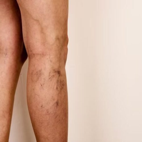 varizes-em-uma-imagem-de-flebologia-de-pernas-femininas-finas_132310-10734