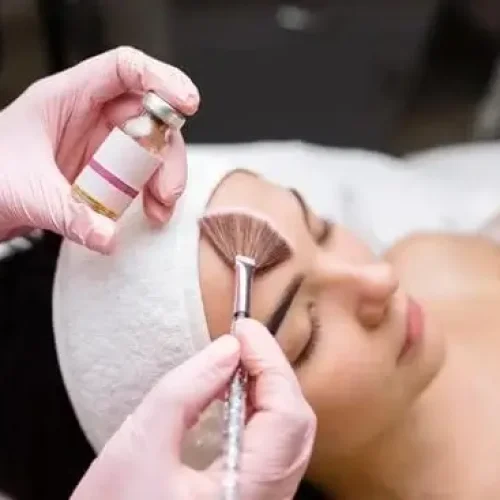 peeling químico em Bauru